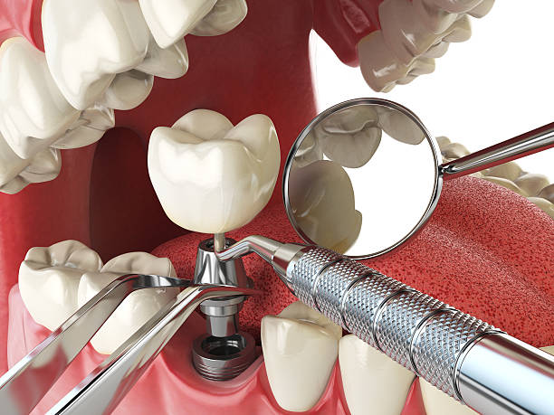 Best Dental Abscess Treatment in Spring Hill, TN